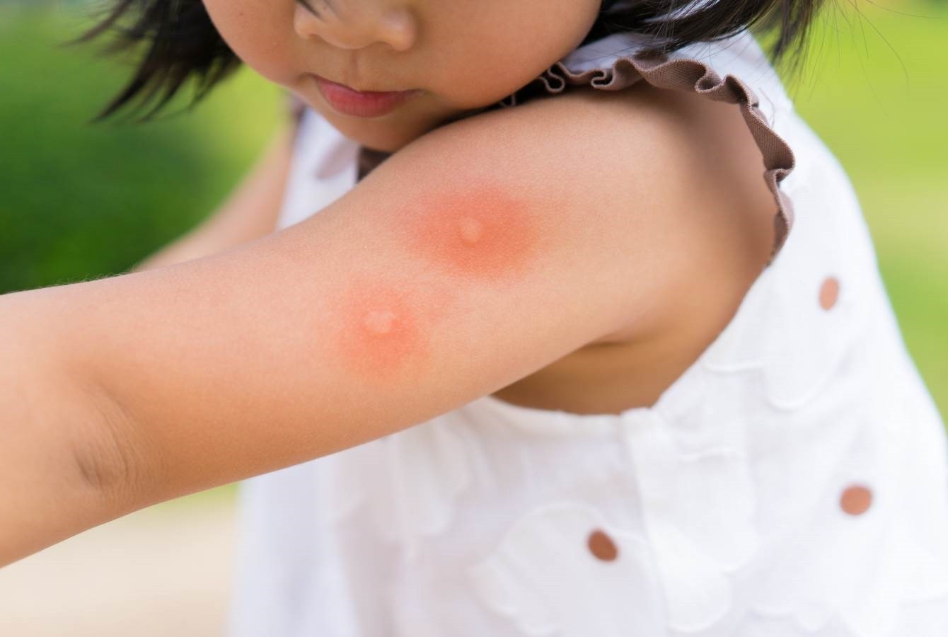 Le punture di zanzara ai bambini : Rimedi prevenzione e cura.